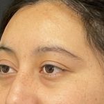 Brow Lift Before & After Patient #6721