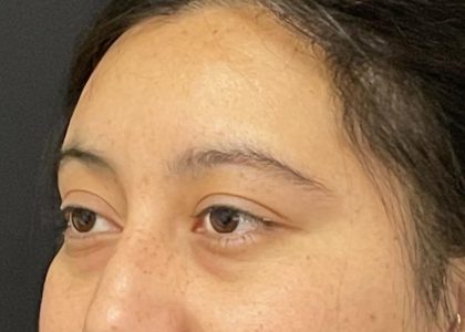 Brow Lift Before & After Patient #6721