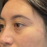 Brow Lift Before & After Patient #6721