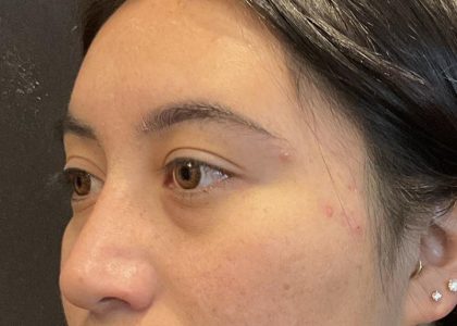 Brow Lift Before & After Patient #6721