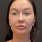 Buccal Fat Pad Removal Before & After Patient #6938