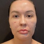 Buccal Fat Pad Removal Before & After Patient #6938