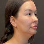 Buccal Fat Pad Removal Before & After Patient #6938