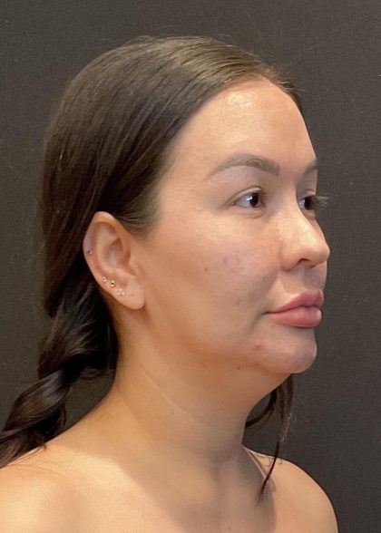 Buccal Fat Pad Removal Before & After Patient #6938