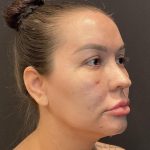 Buccal Fat Pad Removal Before & After Patient #6938