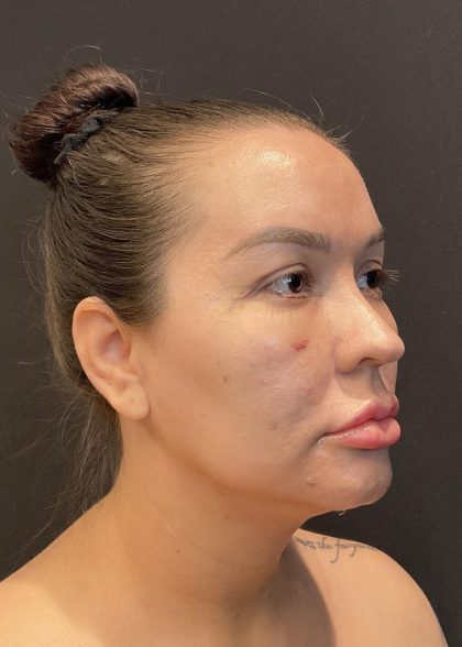 Buccal Fat Pad Removal Before & After Patient #6938
