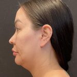 Buccal Fat Pad Removal Before & After Patient #6938