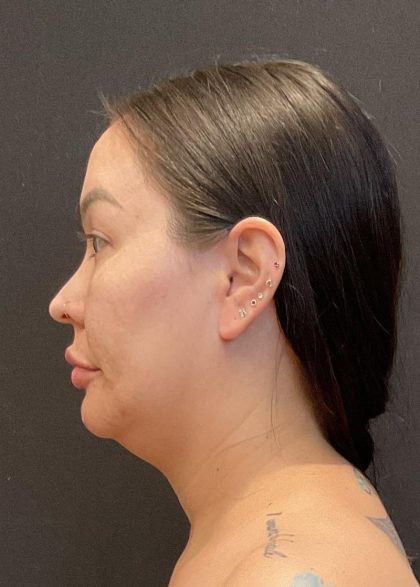 Buccal Fat Pad Removal Before & After Patient #6938