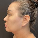Buccal Fat Pad Removal Before & After Patient #6938
