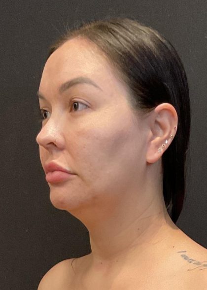 Buccal Fat Pad Removal Before & After Patient #6938