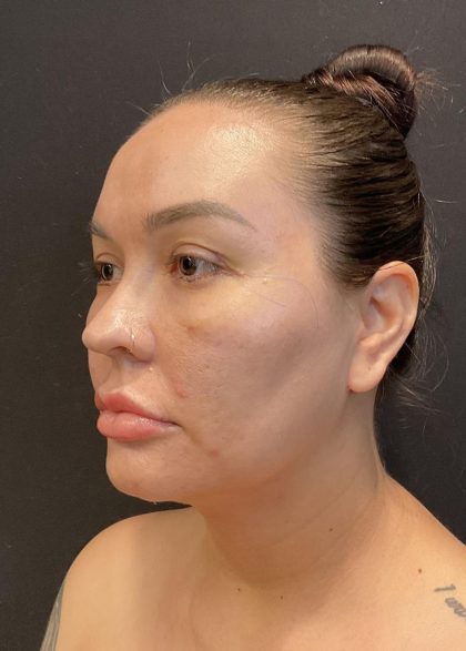 Buccal Fat Pad Removal Before & After Patient #6938