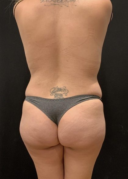 Butt Implants Before & After Patient #6723