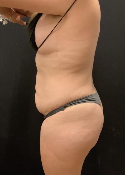 Butt Implants Before & After Patient #6723