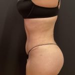 Butt Implants Before & After Patient #6723
