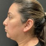 Chin Augmentation Before & After Patient #6355