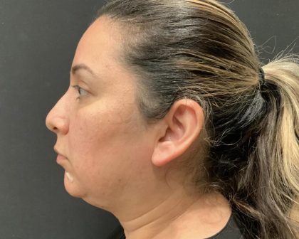 Chin Augmentation Before & After Patient #6355