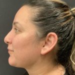 Chin Augmentation Before & After Patient #6355