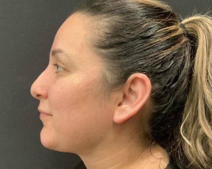 Chin Augmentation Before & After Patient #6355