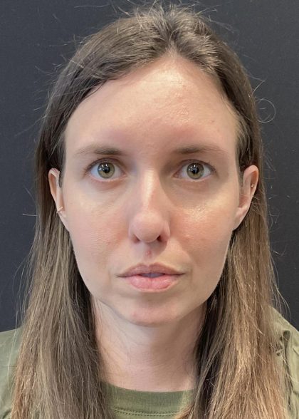 Chin Augmentation Before & After Patient #6356