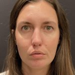 Chin Augmentation Before & After Patient #6356