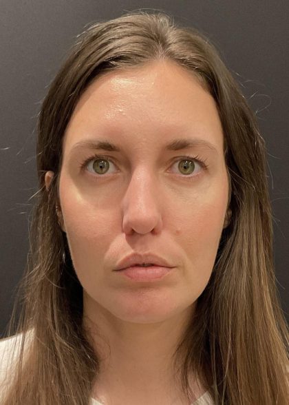 Chin Augmentation Before & After Patient #6356