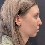 Chin Augmentation Before & After Patient #6356