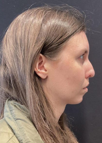 Chin Augmentation Before & After Patient #6356