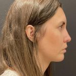 Chin Augmentation Before & After Patient #6356