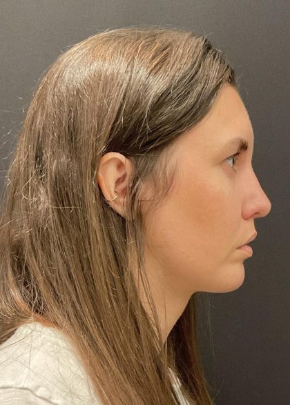 Chin Augmentation Before & After Patient #6356