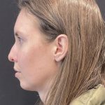 Chin Augmentation Before & After Patient #6356
