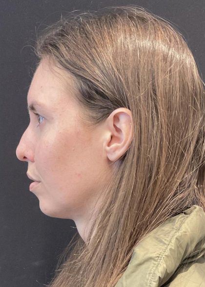 Chin Augmentation Before & After Patient #6356