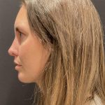 Chin Augmentation Before & After Patient #6356