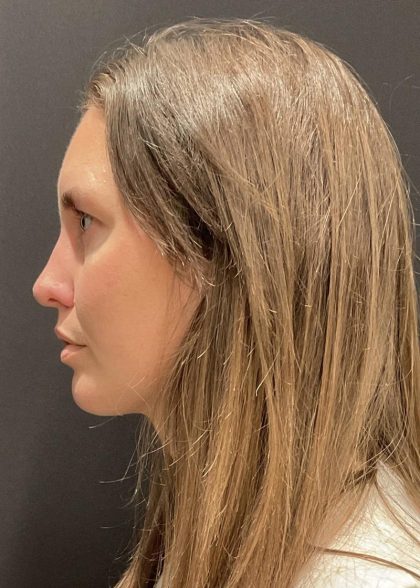 Chin Augmentation Before & After Patient #6356