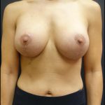 Breast Implant Exchange Before & After Patient #6727