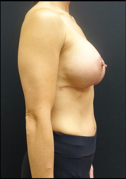 Breast Implant Exchange Before & After Patient #6727