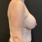 Breast Implant Exchange Before & After Patient #6737
