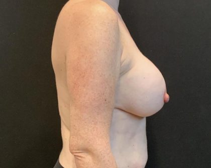 Breast Implant Exchange Before & After Patient #6737