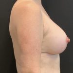 Breast Implant Exchange Before & After Patient #6737