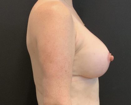 Breast Implant Exchange Before & After Patient #6737