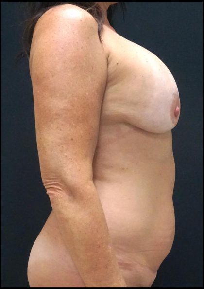 Breast Implant Exchange Before & After Patient #6729