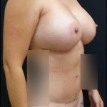 Breast Implant Exchange Before & After Patient #6731