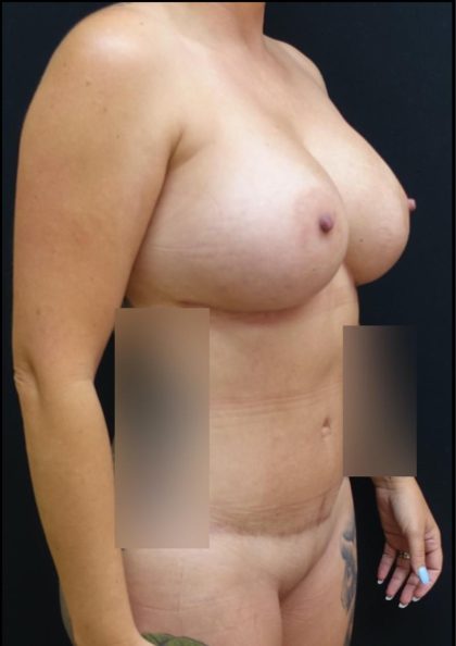 Breast Implant Exchange Before & After Patient #6731