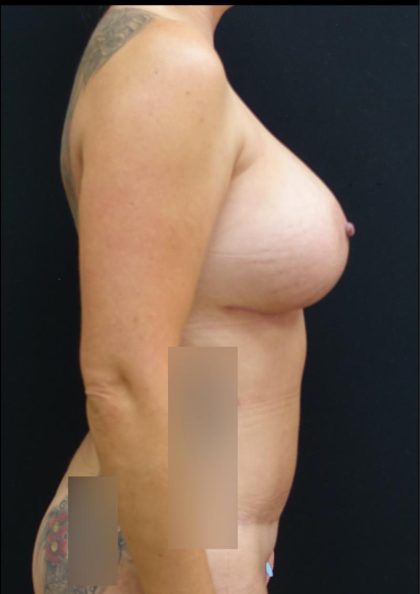 Breast Implant Exchange Before & After Patient #6731