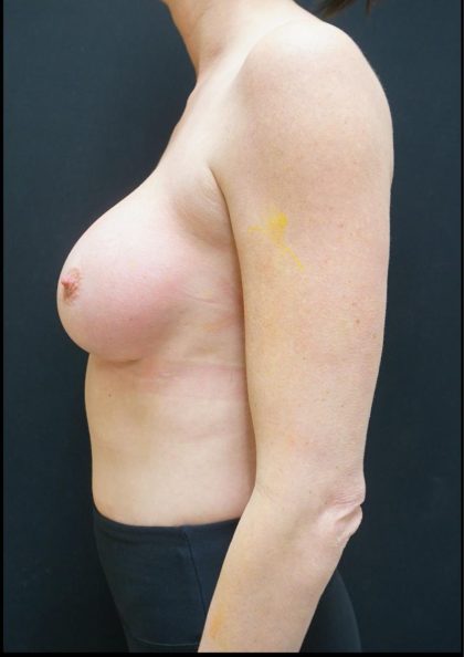 Breast Implant Exchange Before & After Patient #6732