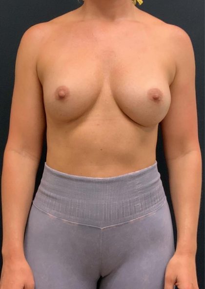 Breast Implant Exchange Before & After Patient #6735