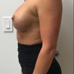 Breast Implant Exchange Before & After Patient #6735