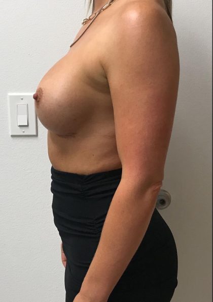 Breast Implant Exchange Before & After Patient #6735