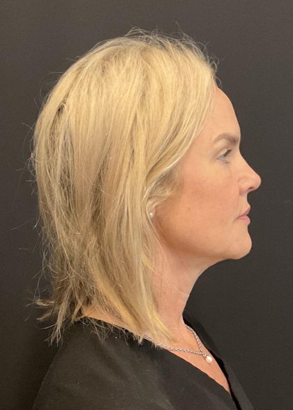 Facelift Before & After Patient #6937