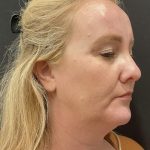 Facelift Before & After Patient #6488