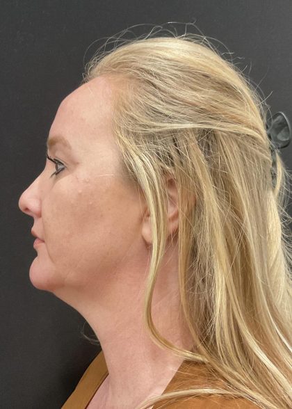 Facelift Before & After Patient #6488